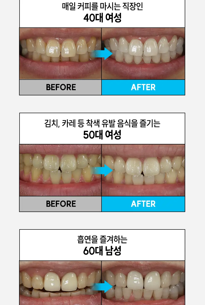 [NEW] 브리올 화이트닝 치아 미백제 4g (치과미백 동일성분) 상세페이지 6